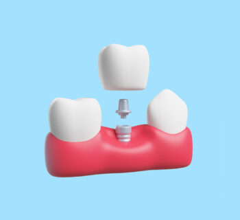 Dental Implant Innovations: What’s Next in Tooth Restoration