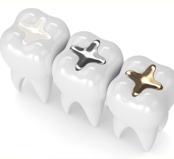 How Often Do Composite Fillings Need To Be Replaced?