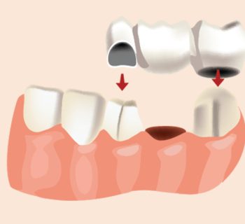 The Top Benefits of Maryland Bridges for Restoring Your Smile